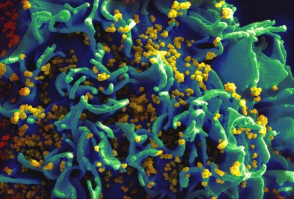 Újabb áttörés a HIV-fertőzés gyógyításában