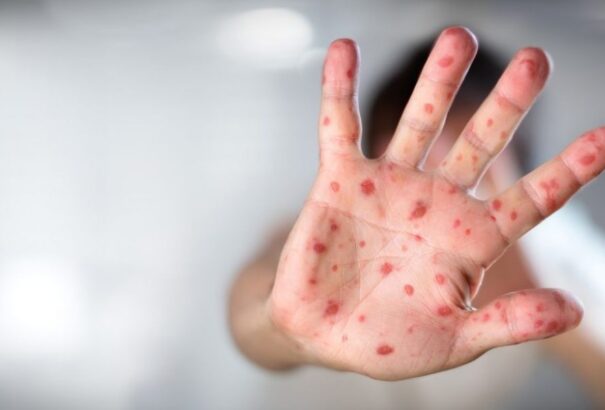 Szlovákiában felütheti fejét a kanyarójárvány, nincs kollektív védettségünk