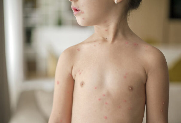 Nyugat felé terjed a kanyaró: már Rozsnyón is felütötte fejét a kór