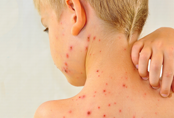 Keleten megállíthatatlanul terjed a kanyaró