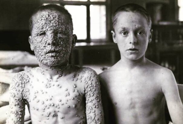 Újra retteghetünk a feketehimlőtől?