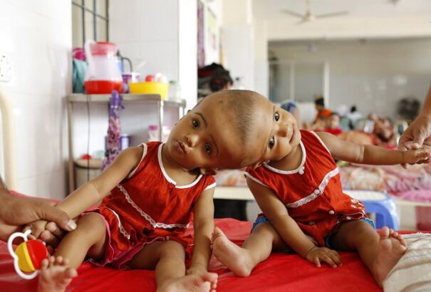 Óriási siker! A magyar orvosok szétválasztották a fejüknél összenőtt sziámi ikreket