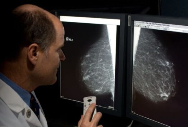 A mesterséges intelligencia jobban felismeri a mellrákot