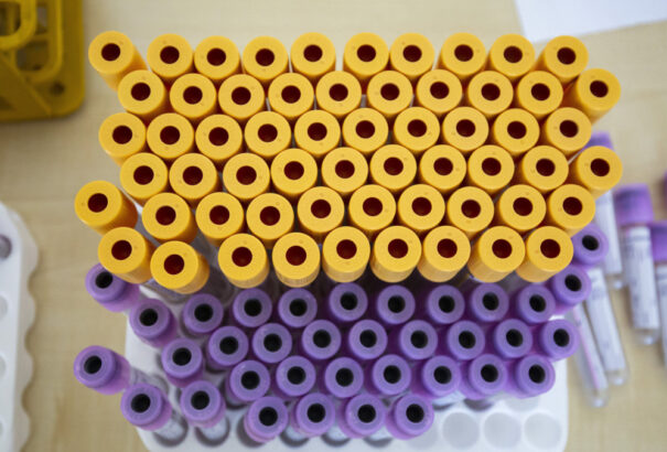 Koronavírus – Meghalt 84 beteg, 3928-cal nőtt a fertőzöttek száma Magyarországon