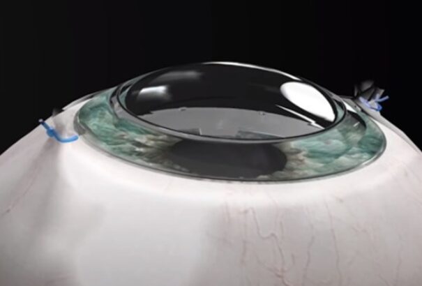 Mesterséges szaruhártyát kapott a 78 éves férfi, visszanyerte a látását