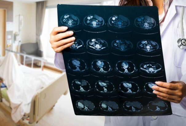 A WHO szerint katasztrofálisan hat a világjárvány a rákgyógyításra