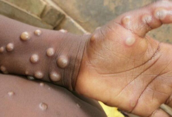 Terjed a majomhimlő a világban. Ezt kell tudni a betegségről és a kezeléséről