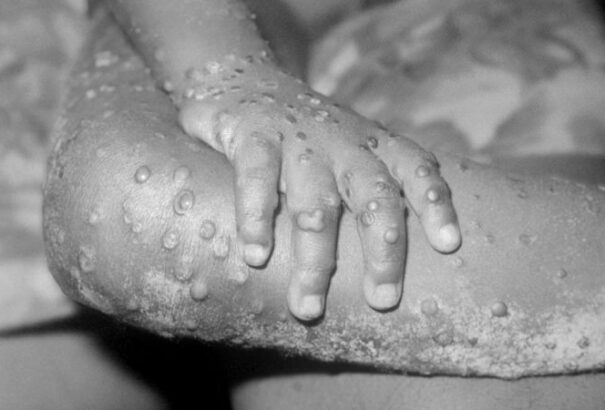 Belgium az első ország, ahol bevezetik a kötelező majomhimlő-karantént