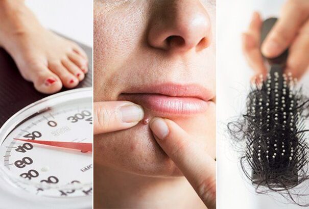 Tudja mi az a policisztás petefészek szindróma? Ez a női meddőség egyik leggyakoribb oka