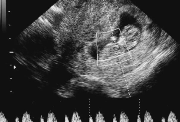 Méhen belül műtötték meg egy 34 hetes magzat agyát, sikerült megmenteni az életét