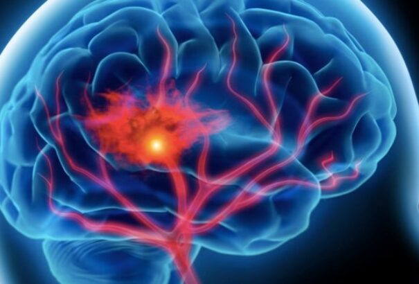 Ijesztő hír jött az agyvérzésről