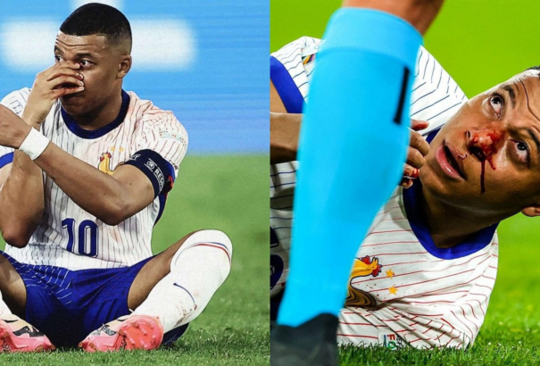 Eltört Mbappé orra