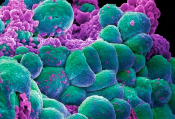 92 százalékos pontosság szúrás nélkül: Magyarországon is elérhetővé vált a rákot kimutató DNS-teszt