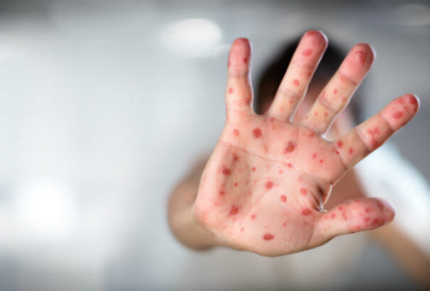 Kanyarójárvány terjed Észak-Amerikában, már Kanadát is elérte