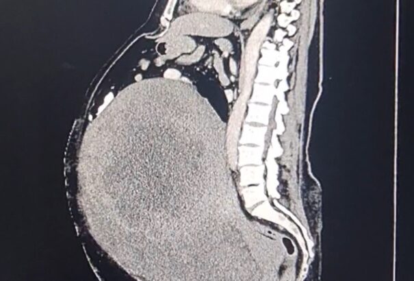 A komáromi kórházban sikeresen eltávolítottak egy közel 19 kilós daganatot